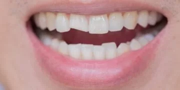 Złamany Ząb – Znaczenie I Symbolika Snów 12